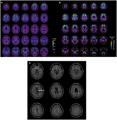 Case Report: 18F-MK6240 Tau Positron Emission Tomography Pattern Resembling Chronic Traumatic Encephalopathy in a Retired Australian Rules Football Player